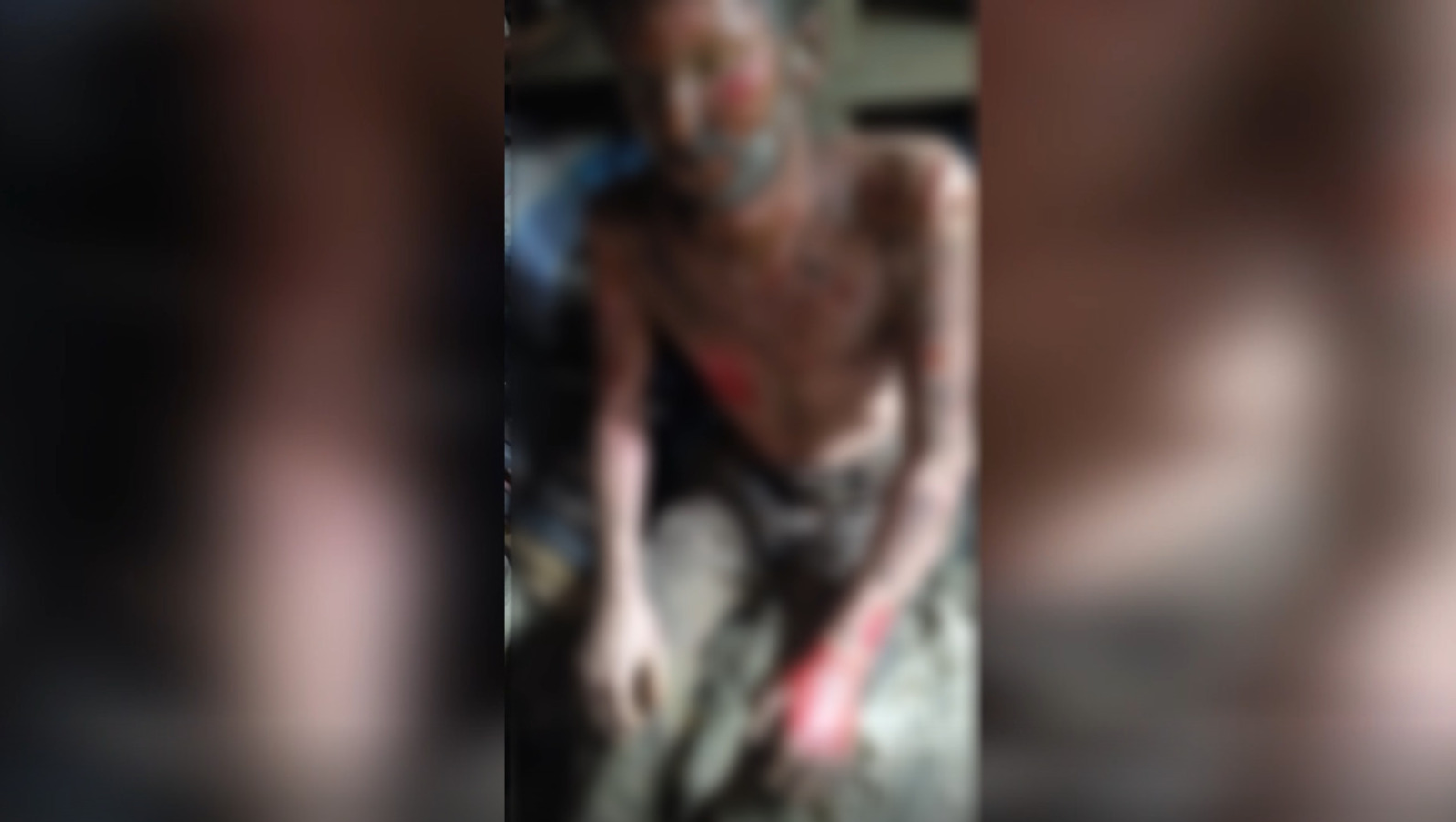 Обгоревшего бойца из Башкирии месяц спасали наши дроны